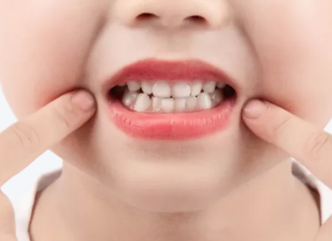 涂氟后多久能刷牙？河北惟德口腔醫(yī)生專(zhuān)業(yè)答疑