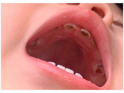 河北惟德口腔涂氟流程簡單，孩子配合度拉滿