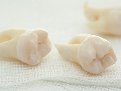 智齒疼了，這牙非拔不可嗎？