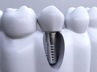 承德種植牙價格表，2024種植牙多少錢一顆呢?