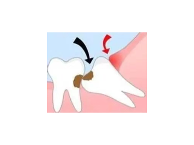 吃完飯后老塞牙？別大意！這可能是你的牙齒在報(bào)警