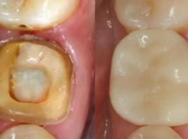 根管治療（抽神經(jīng)）后，為什么一定要做牙冠？