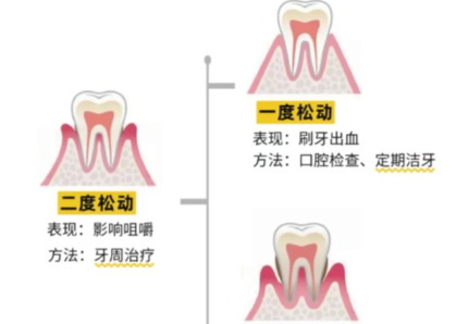 老年人牙齒松動(dòng)了要怎么辦？