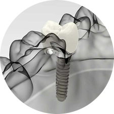 術(shù)前研究、模擬提升種植成功率
