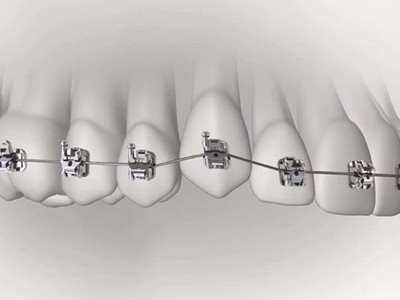 承德市哪家口腔醫(yī)院口腔正畸做得好？惟德口腔醫(yī)院來(lái)告訴您