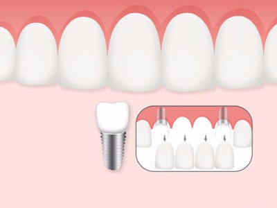 惟德口腔口腔種植怎么樣？惟德口腔就來為您一一解答