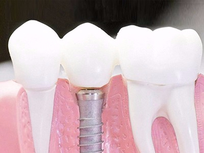 在承德口腔種植齒需要多少錢？惟德口腔一一為您道來